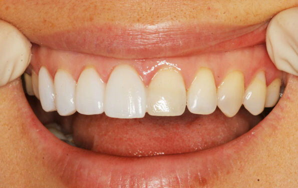 Types facettes dentaires : facettes en composite et en céramique
